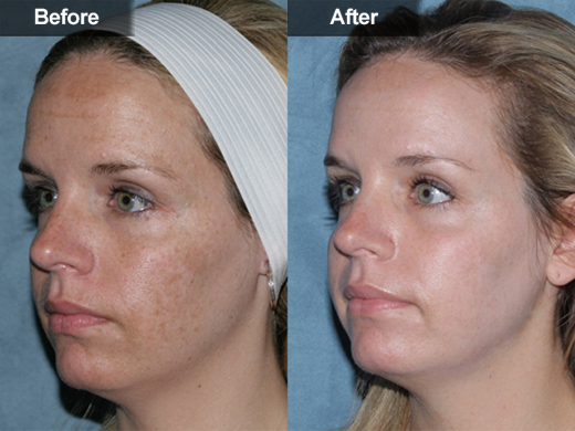 Age &amp; Brown Spots Removal | Vienna, Stafford, Woodbridge, VA