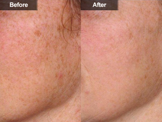 Laser Surgery: How Much Is Laser Removal Cost Of Does ...
