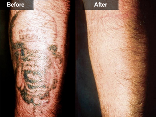 Tattoo Removal | Mclean &amp; Woodbridge Virginia | Skin &amp; Laser Surgery ...