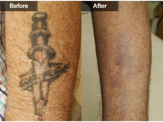 tattoo removal mclean u0026 woodbridge virginia skin u0026 laser tattoo removal mclean u0026 woodbridge virginia skin u0026 laser