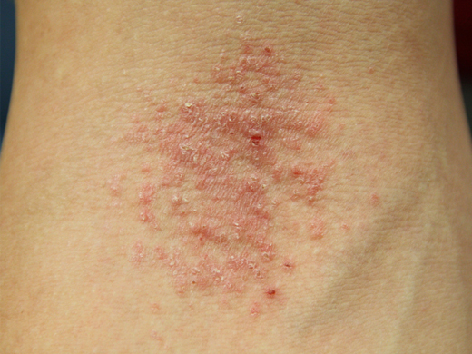 allergic contact dermatitis Picture Image on MedicineNet.com