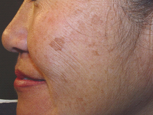 What causes melasma? - MedicineNet