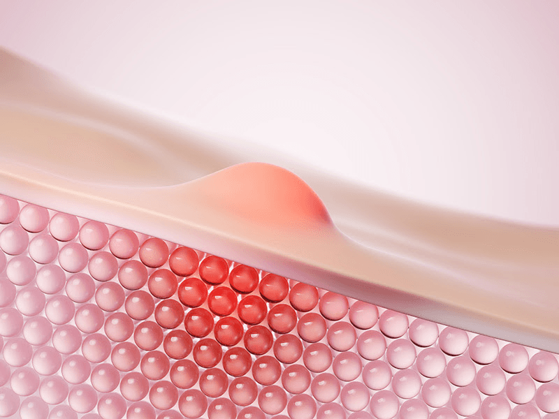 Medical illustration showing inflammation beneath an acne lesion