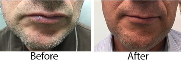 Laser Treatment for Venous Lake (purple or blue bumps on the lips)