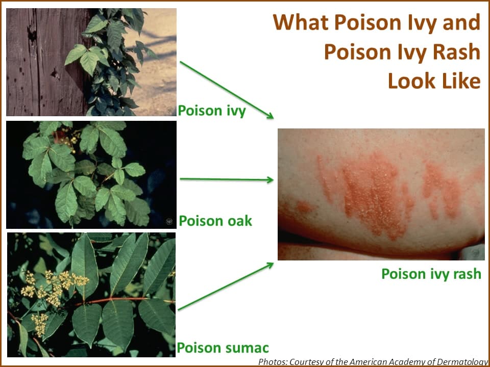 Comparison of poison ivy, poison oak, poison sumac, and a poison ivy rash