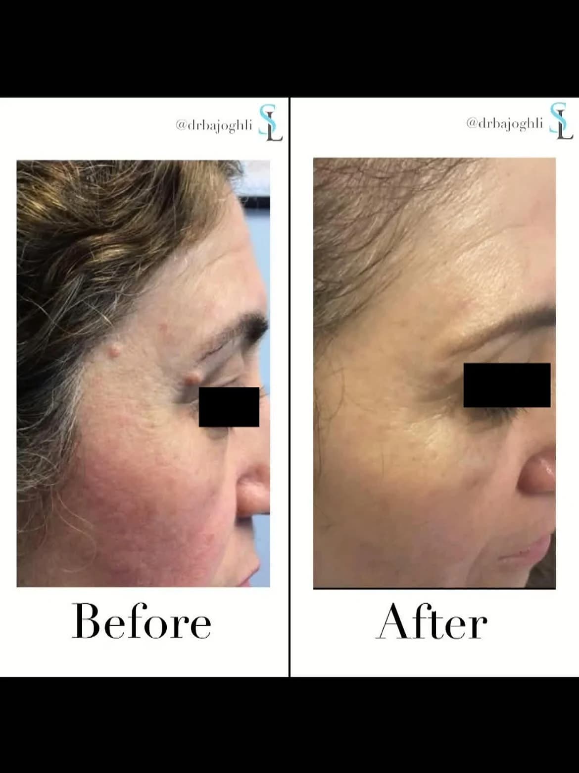 Benign moles near the eye and forehead before and after CO2 laser treatment