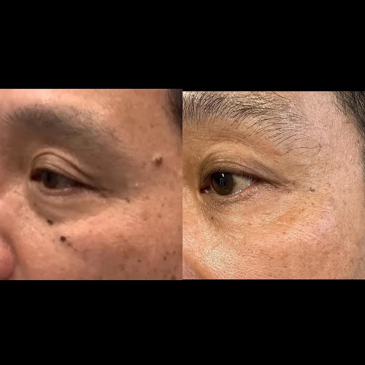 Brown spots below the eyelid and outside the eyebrow before and after PicoWay and CO2 laser treatment