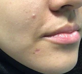 Right chin after one CO2 laser treatment for a raised benign mole