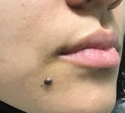 Raised benign mole on the right chin before CO2 laser treatment