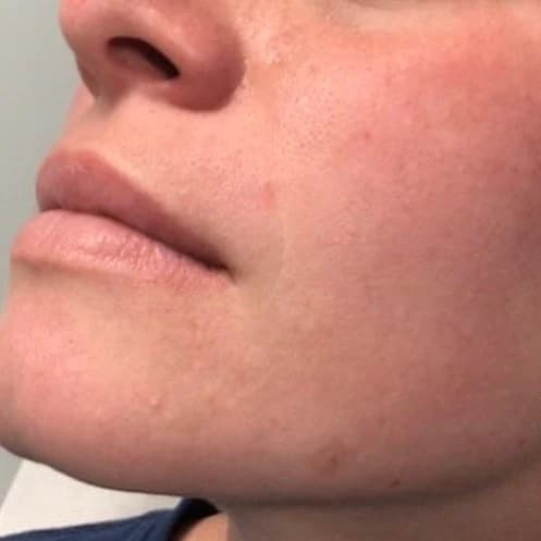 Detailed view of the chin after one laser mole removal session