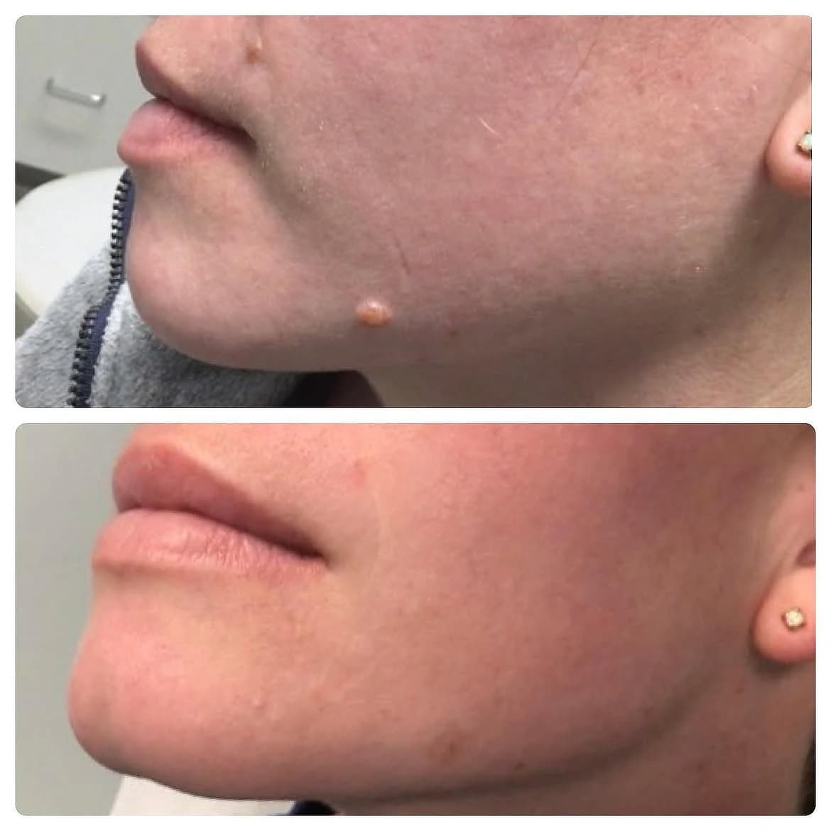 Raised mole along the chin before and after one laser removal session