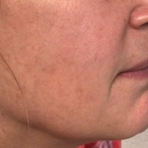Detailed view of the cheek after one laser mole removal session
