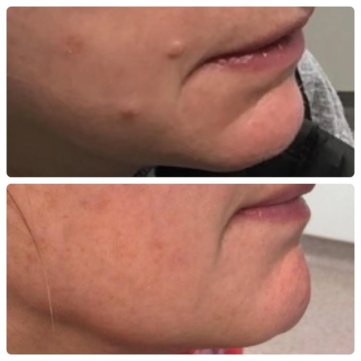 Raised mole on the lower cheek before and after one laser removal session