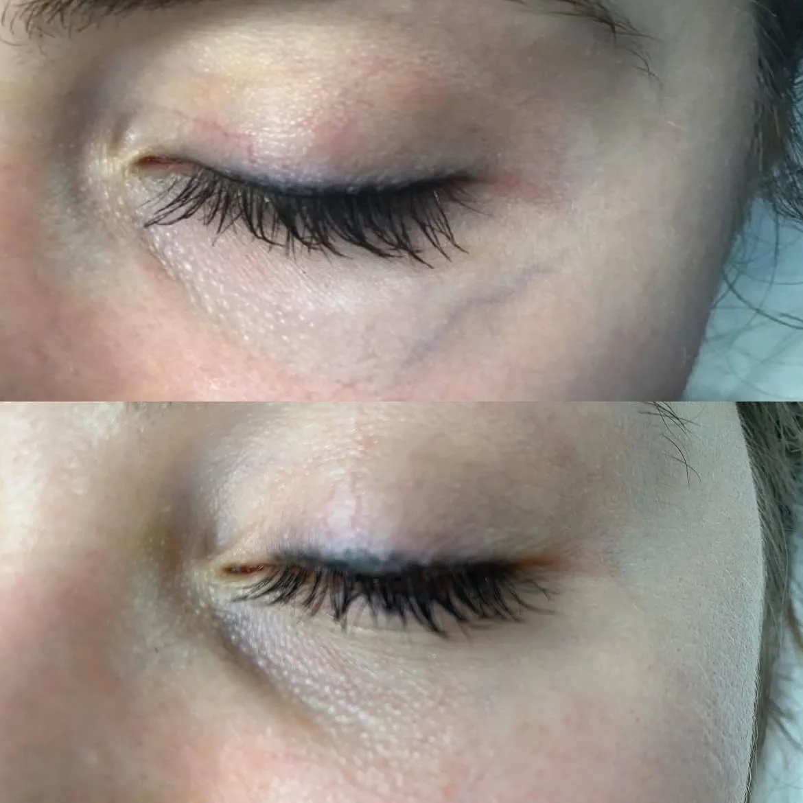 Visible facial spider veins before and after one Nd:YAG laser treatment