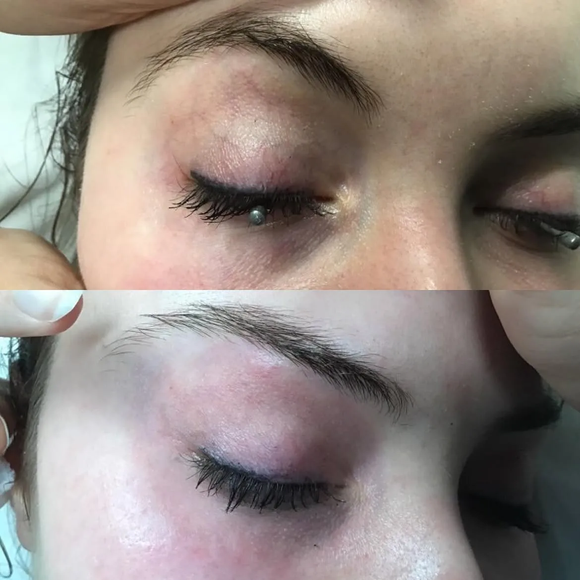 Visible facial veins near the eye before and after vascular laser treatment