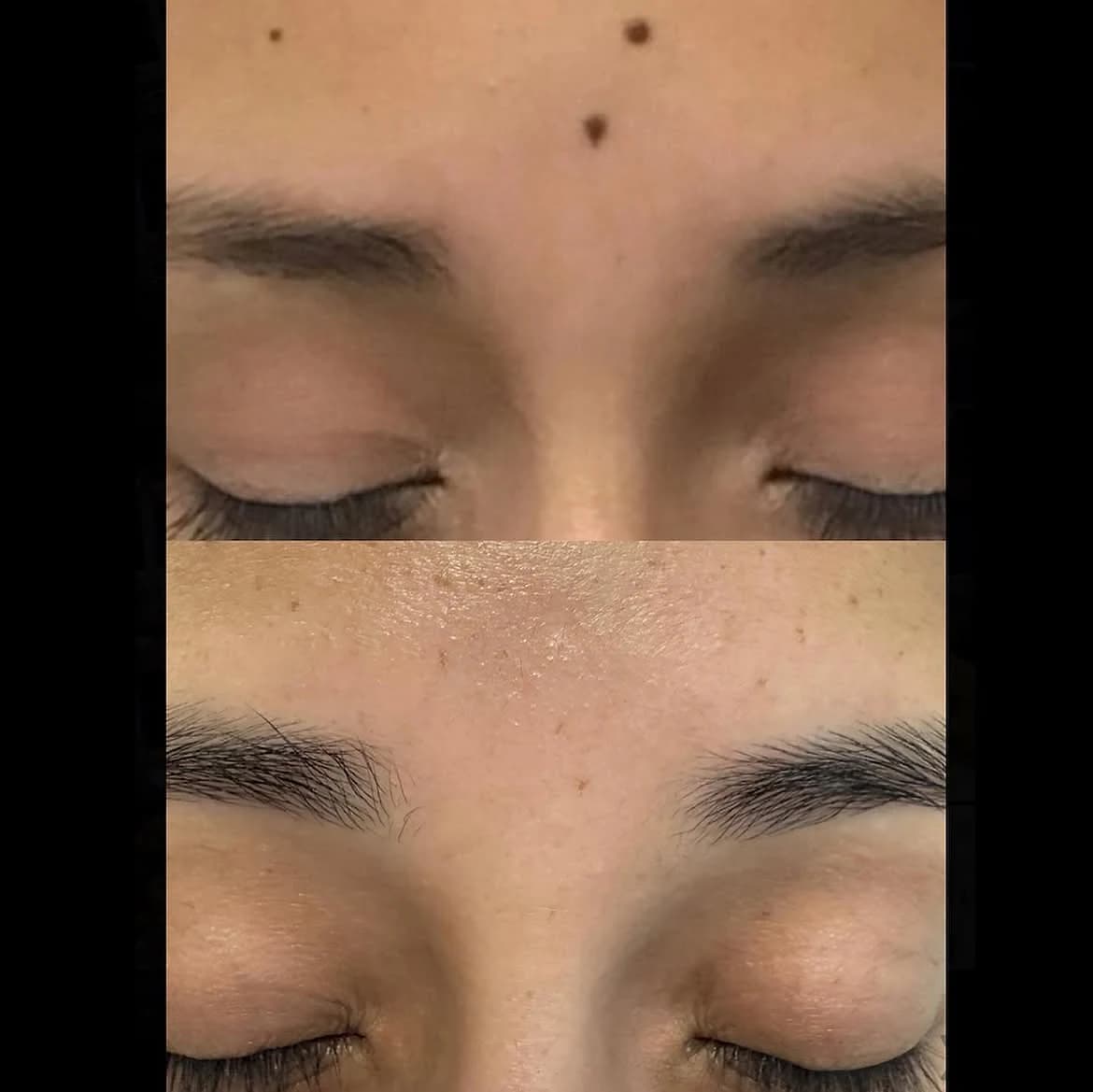Forehead moles before and after CO2 laser removal