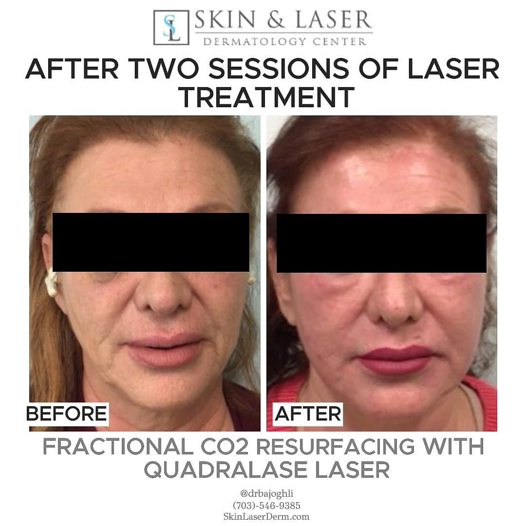Front-view comparison before and after two fractional CO2 resurfacing sessions
