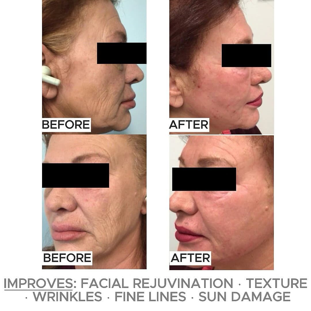 Side-view comparisons before and after two fractional CO2 resurfacing sessions