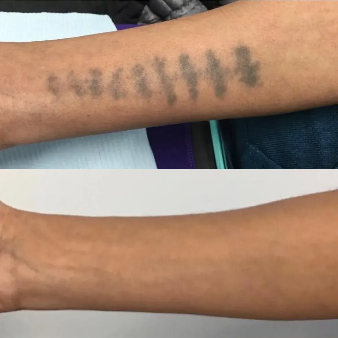 Dark forearm tattoo before treatment and faded skin after laser tattoo removal