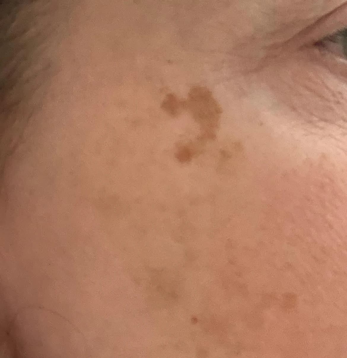 Facial lentigo before Q-switched Nd:YAG laser treatment