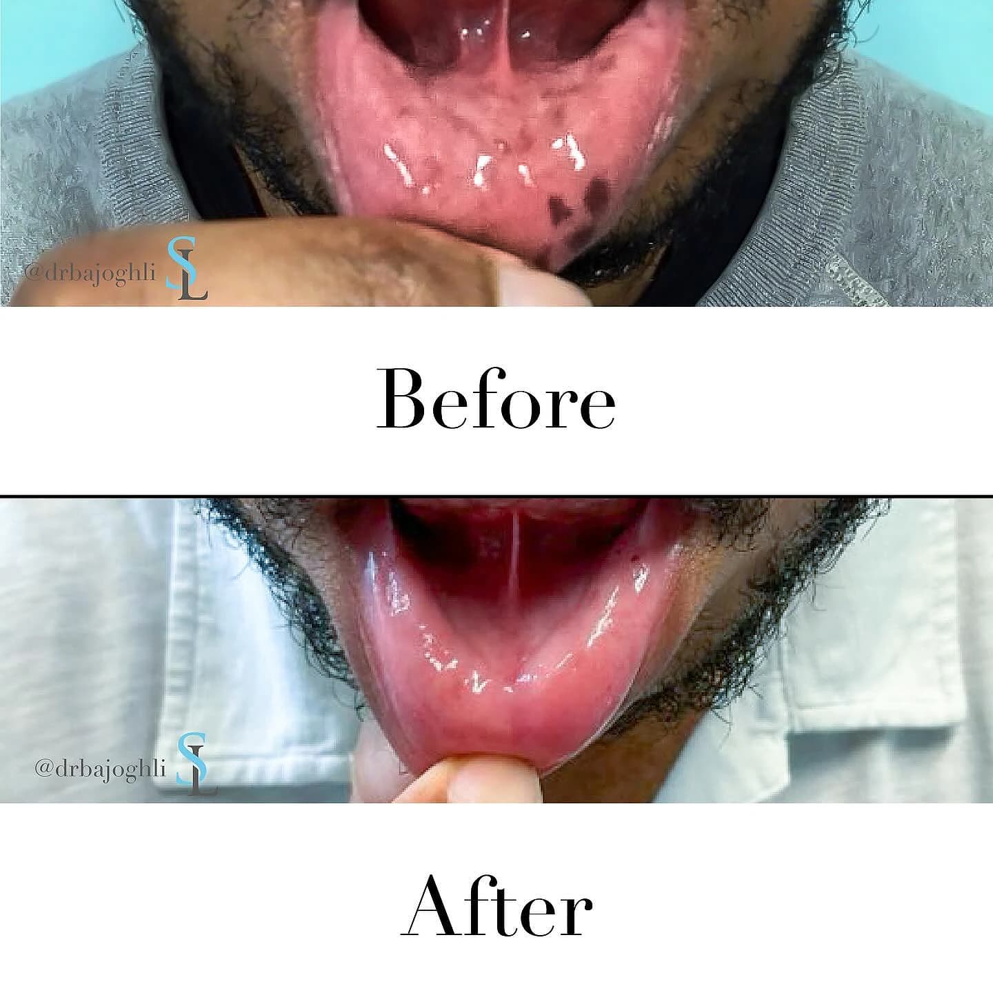 Pigmented spots on the inner lower lip before and after one PicoWay laser treatment