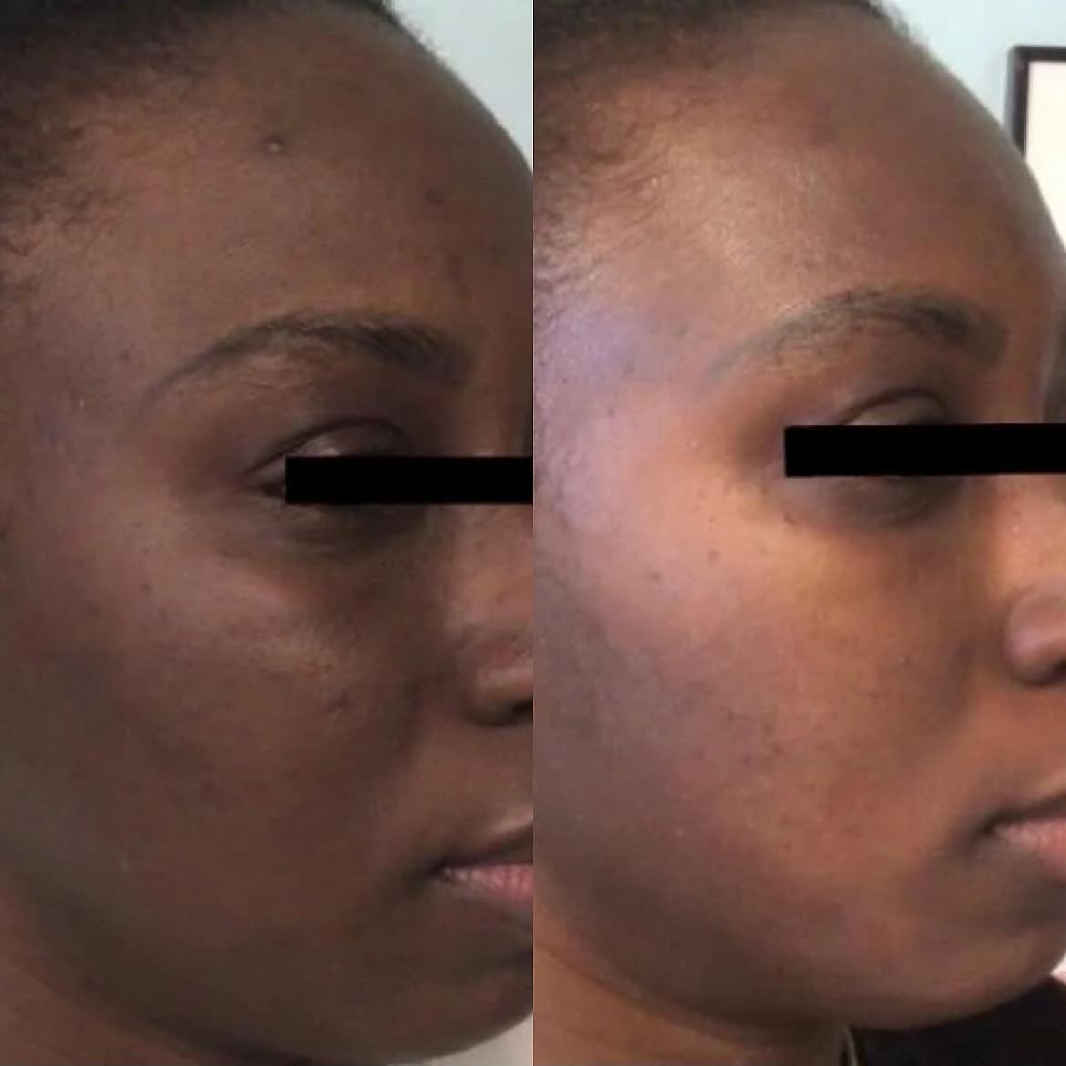 Facial melasma and uneven pigmentation before and one month after a Melange chemical peel