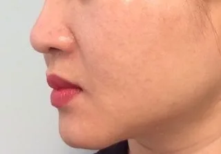 More even-looking facial pigmentation after four PicoWay laser treatment sessions for melasma