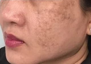 Patchy facial melasma before four PicoWay laser treatment sessions