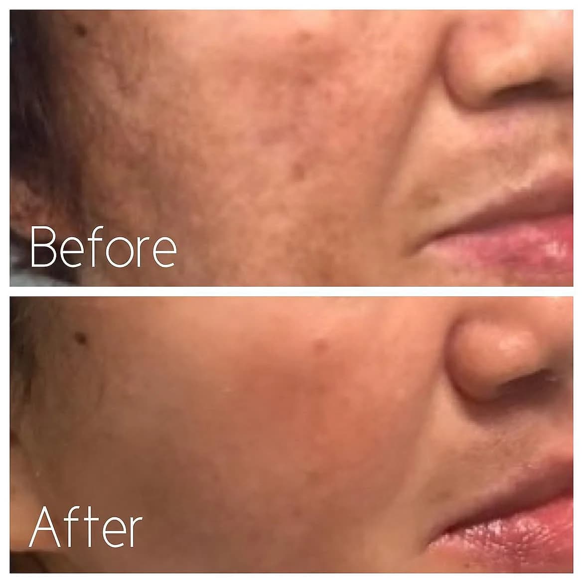 Right side of the face before and after two melasma treatment sessions