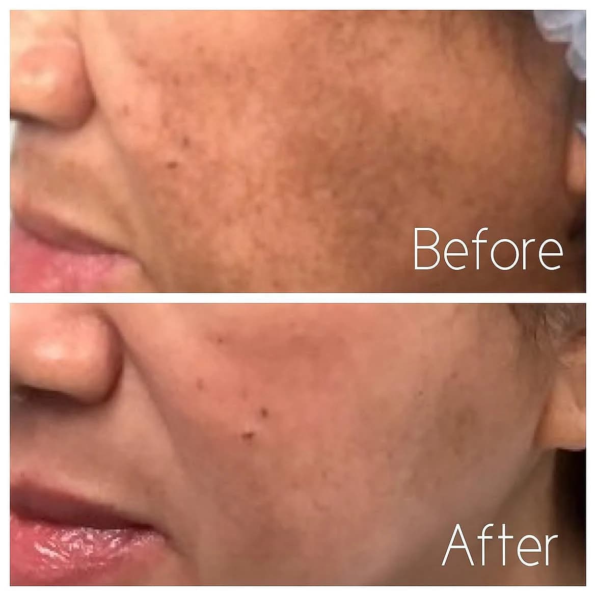Left side of the face before and after two melasma treatment sessions