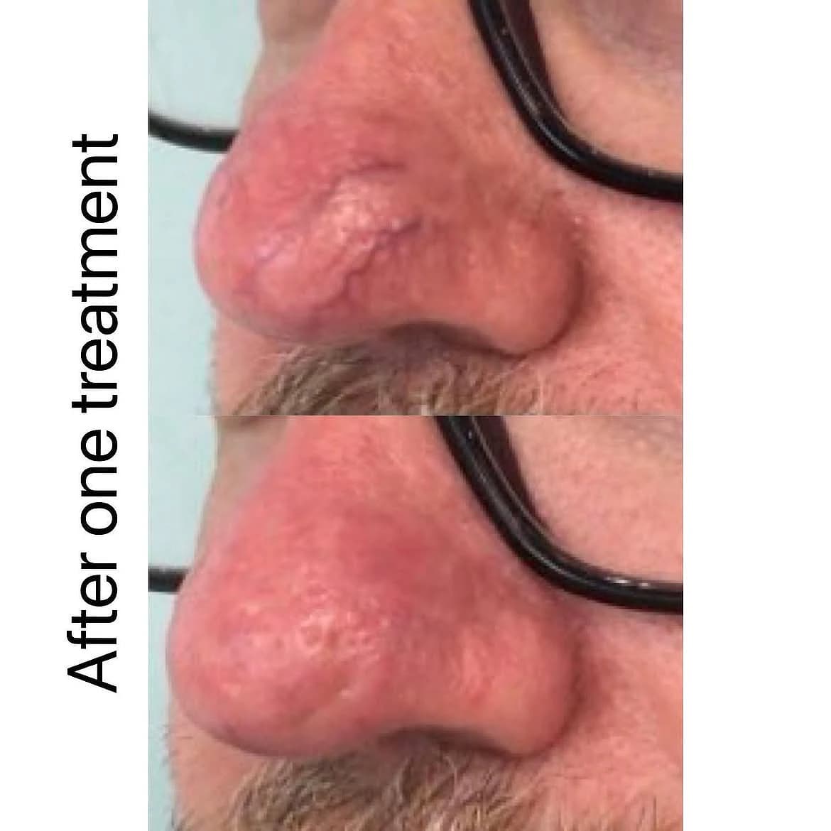 Visible veins on the nose before and after one vascular laser treatment session