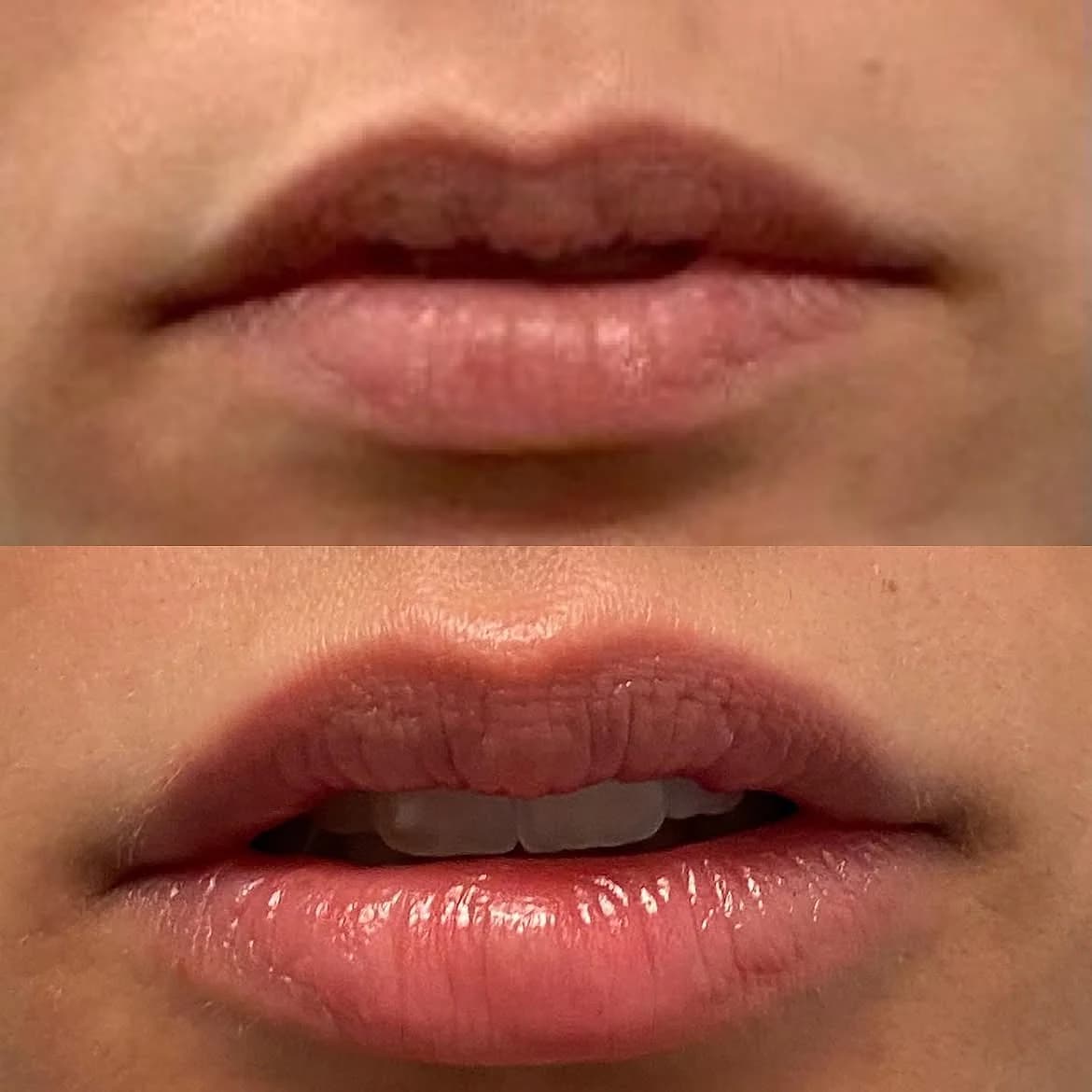 Lips before and after enhancement with one milliliter of Restylane filler