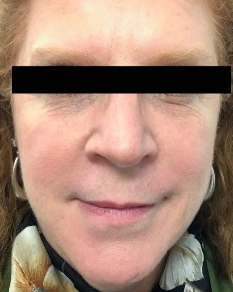 Smoother under-eye contours after Restylane dermal filler treatment for tear troughs