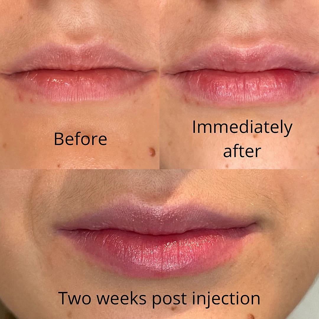 Lips before RHA filler, immediately after injection, and two weeks after treatment