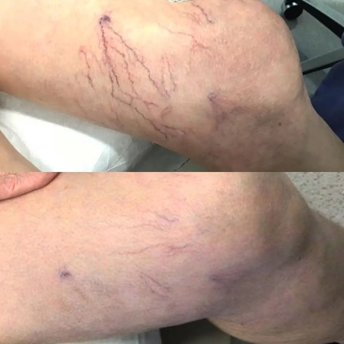 Visible leg spider veins before and after sclerotherapy treatment