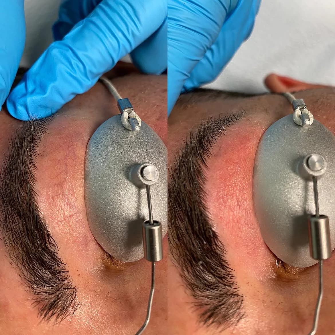Facial telangiectasia near the eye before and moments after GentleYAG laser treatment