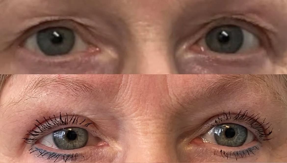 Upper eyelids before and after removal of excess skin with blepharoplasty