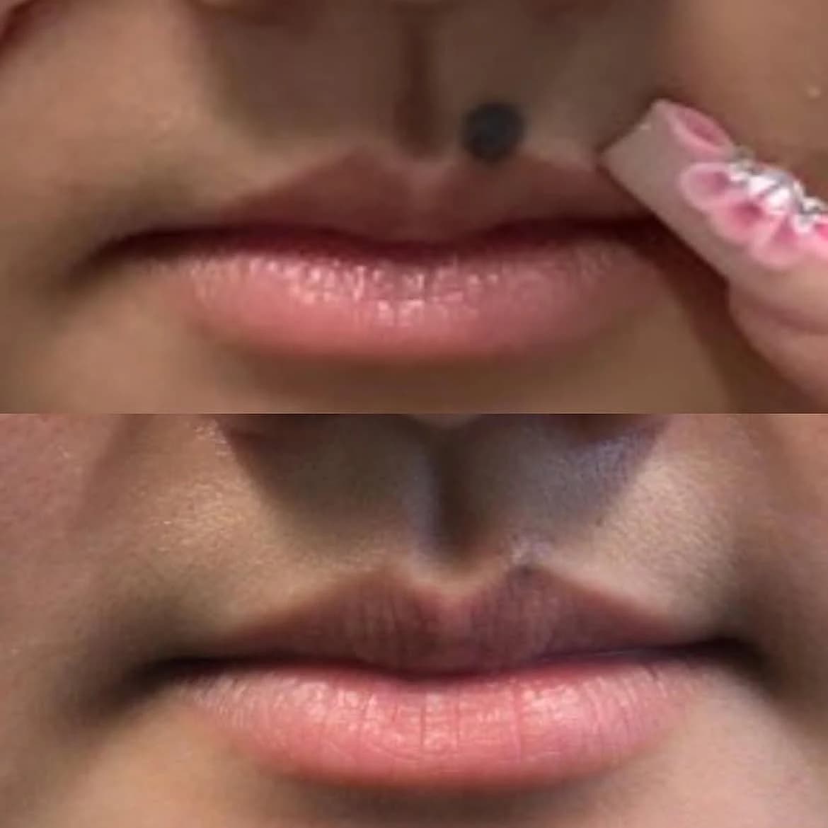 Mole above the upper lip before and after one laser removal session