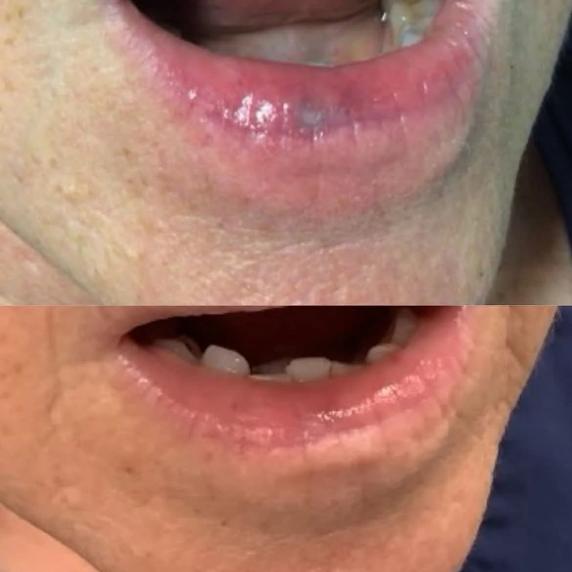 Venous lake on the lower lip before and after laser treatment