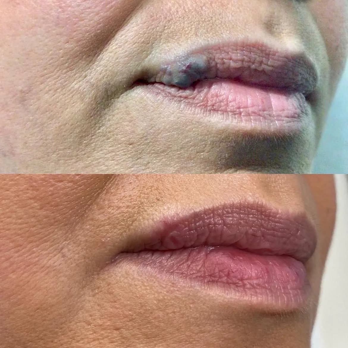 Long-standing venous lake on the upper lip before and after one brief laser treatment