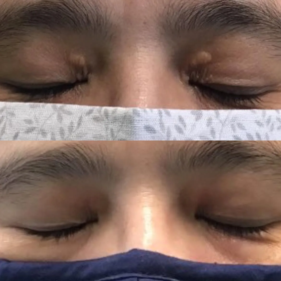 Yellow xanthelasma plaques on the upper eyelids before and after CO2 laser treatment