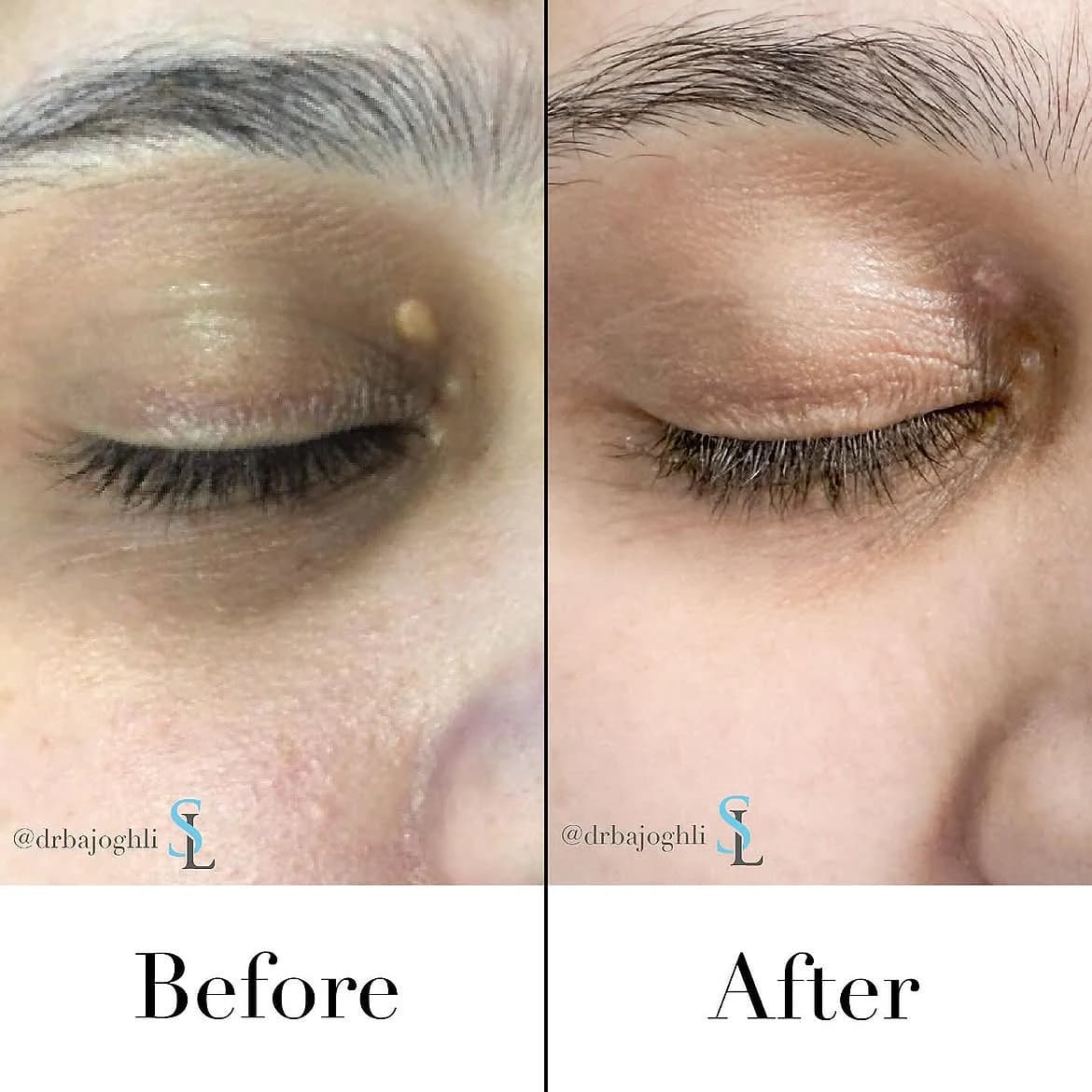 Eyelid xanthelasma before treatment and three weeks after one CO2 laser session