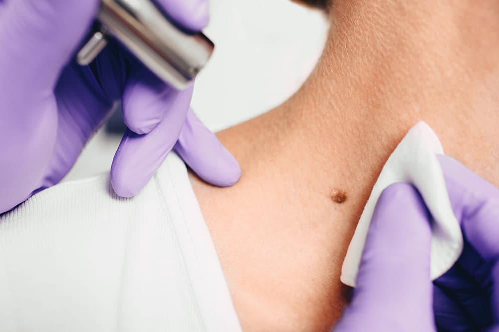 Benign Moles and Mole Removal | DPN