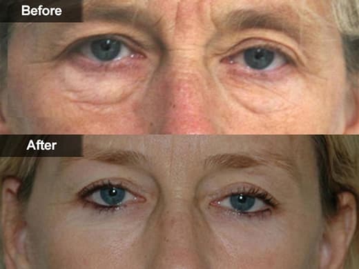 Blepharoplasty Eyelid Surgery clinical photo