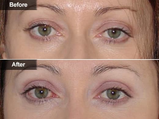 Blepharoplasty Eyelid Surgery clinical photo