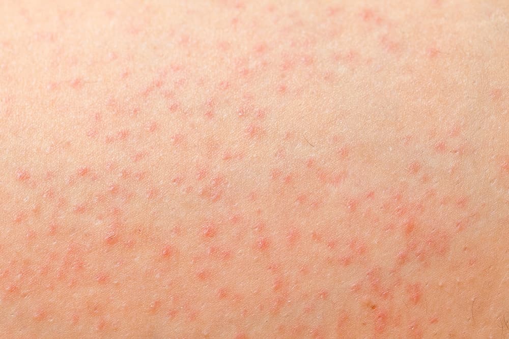 Folliculitis