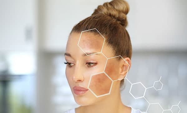 Hyperpigmentation