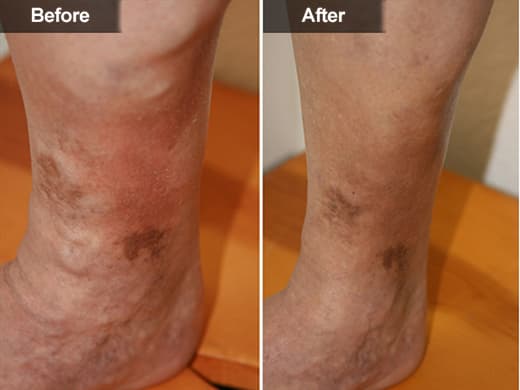 Sclerotherapy (Leg Vein Treatment) clinical photo
