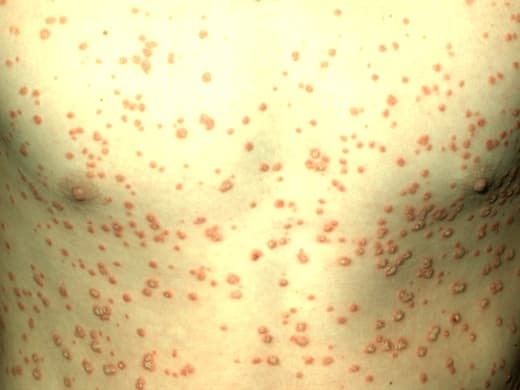 Psoriasis clinical photo