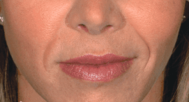 Restylane Lyft (formerly called "Perlane")